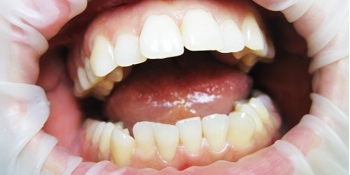 Лазерное отбеливание зубов - фото №2