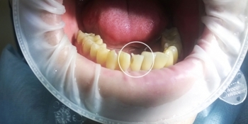 Восстановление зуба с помощью композитного материала - фото №1