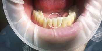 Восстановление зуба с помощью композитного материала - фото №2