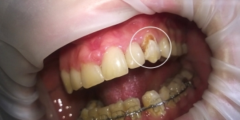 Восстановление зуба композитным материалом «Estelitе» и лечение кариеса - фото №1