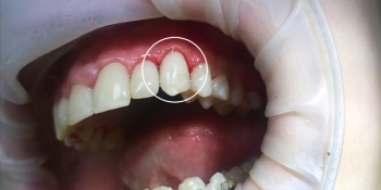 Восстановление зуба композитным материалом «Estelitе» и лечение кариеса - фото №2