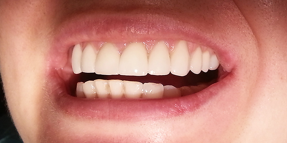 Реконструкция улыбки с помощью керамических виниров E-MAX стандарт - фото №2
