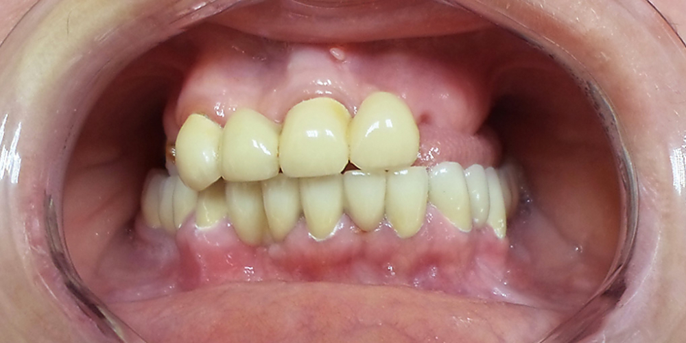 Протезирование зубов верхней челюсти при потере большого количества зубов - фото №1