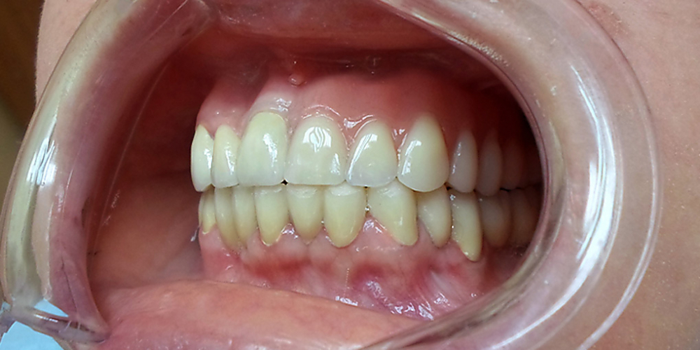 Протезирование зубов верхней челюсти при потере большого количества зубов - фото №2