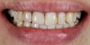 Эстетическая реставрация передних зубов с помощью виниров E.MAX - фото №1