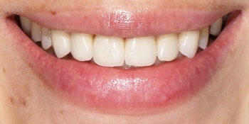 Эстетическая реставрация передних зубов с помощью виниров E.MAX - фото №2