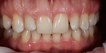 Эстетическая реставрация зубов винирами E.MAX - фото №1