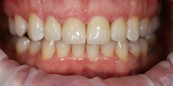 Эстетическая реставрация зубов винирами E.MAX - фото №2
