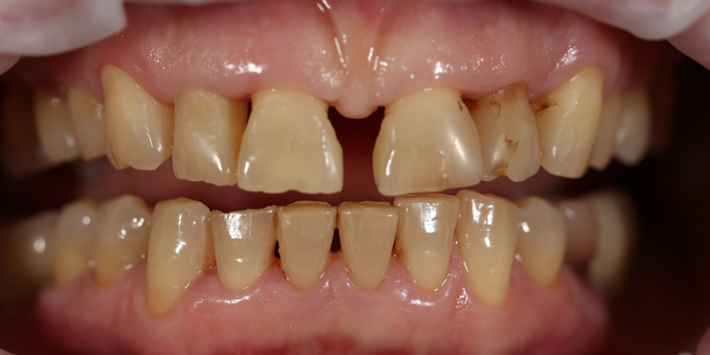 Устранение щели между передними зубами с помощью виниров E-MAX - фото №1