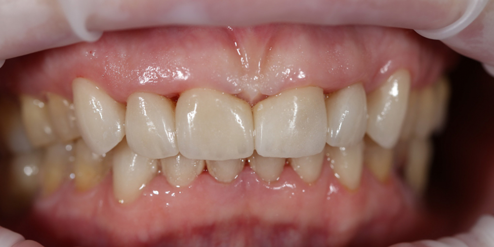 Устранение щели между передними зубами с помощью виниров E-MAX - фото №2