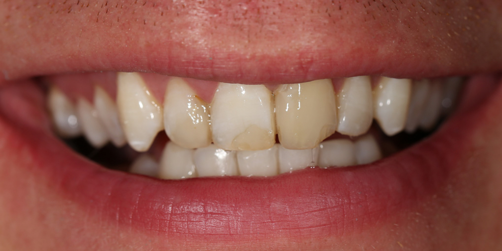 Сделать цвет зубов равномерным и естественным, убрать сколы и выровнять несимметричные края зубов - фото №1
