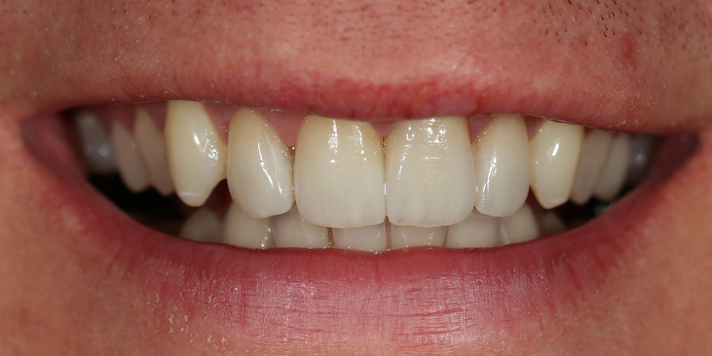 Сделать цвет зубов равномерным и естественным, убрать сколы и выровнять несимметричные края зубов - фото №2