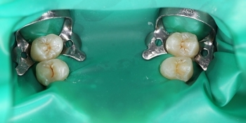 Герметизация фиссур 4 молочных зубов - фото №1