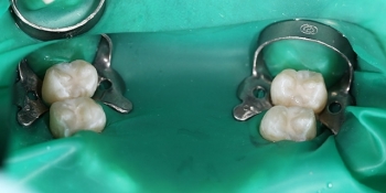 Герметизация фиссур 4 молочных зубов - фото №2