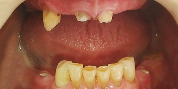 Полное протезирование зубов на имплантах - фото №1