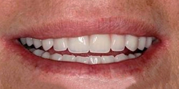 Полное протезирование зубов на имплантах - фото №2