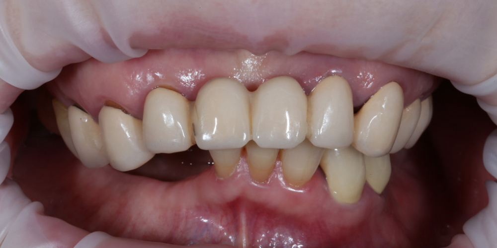 Установка телескопических зубных протезов на импланты - фото №1