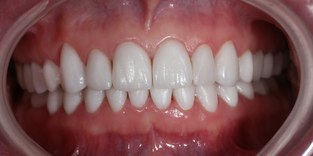 Реконструкция зубов керамическими винирами - фото №2