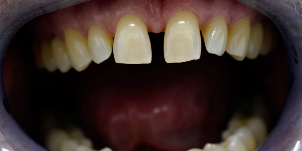 Закрытие диастемы зубов керамическими винирами - фото №1