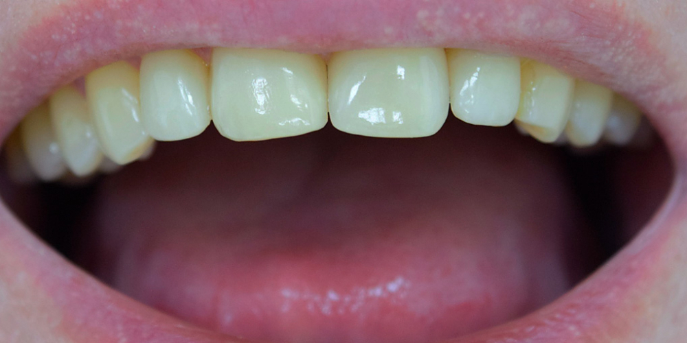 Закрытие диастемы зубов керамическими винирами - фото №2