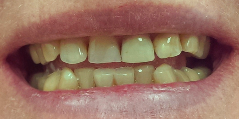 Изготовление и установка керамических виниров E-MAX на передние зубы - фото №1