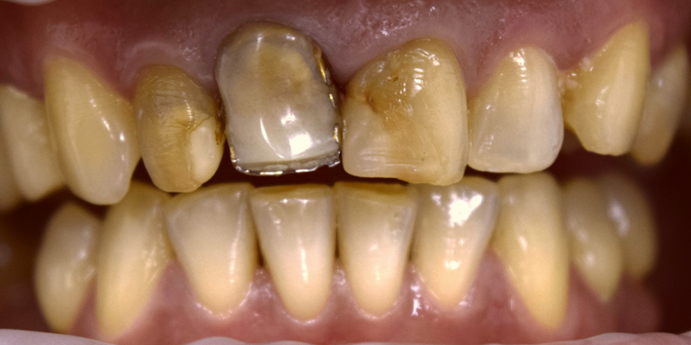 Лечение десен и эстетическая реставрация передних зубов - фото №1
