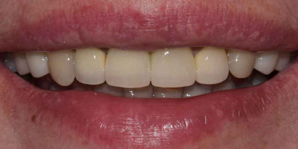 Лечение десен и эстетическая реставрация передних зубов - фото №2