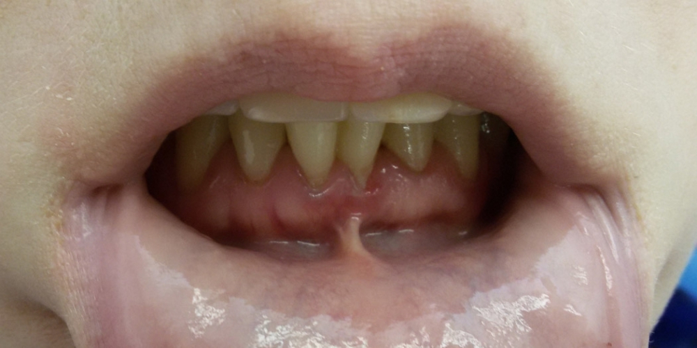 Результат лечения оголения корней передних зубов - фото №1