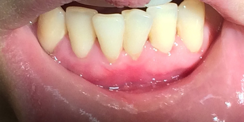 Результат лечения оголения корней передних зубов - фото №2