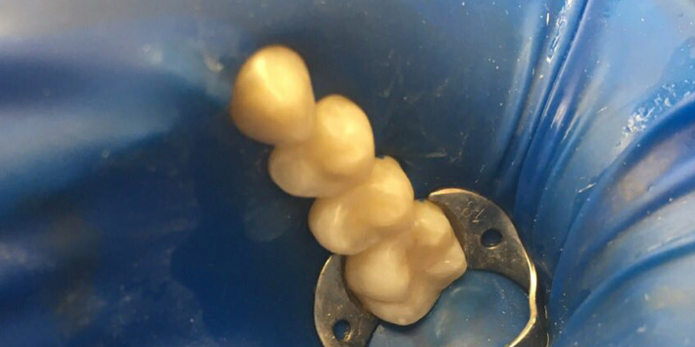 Лечение кариеса двух жевательных зубов - фото №3