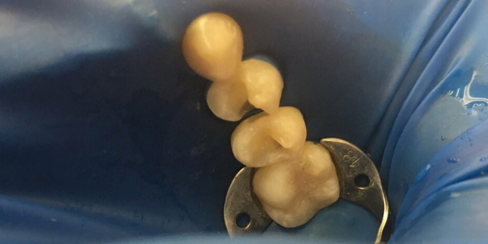 Лечение кариеса двух жевательных зубов - фото №2