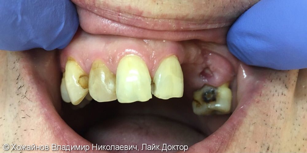 Травма в области 4 зубов верхней челюсти - фото №1