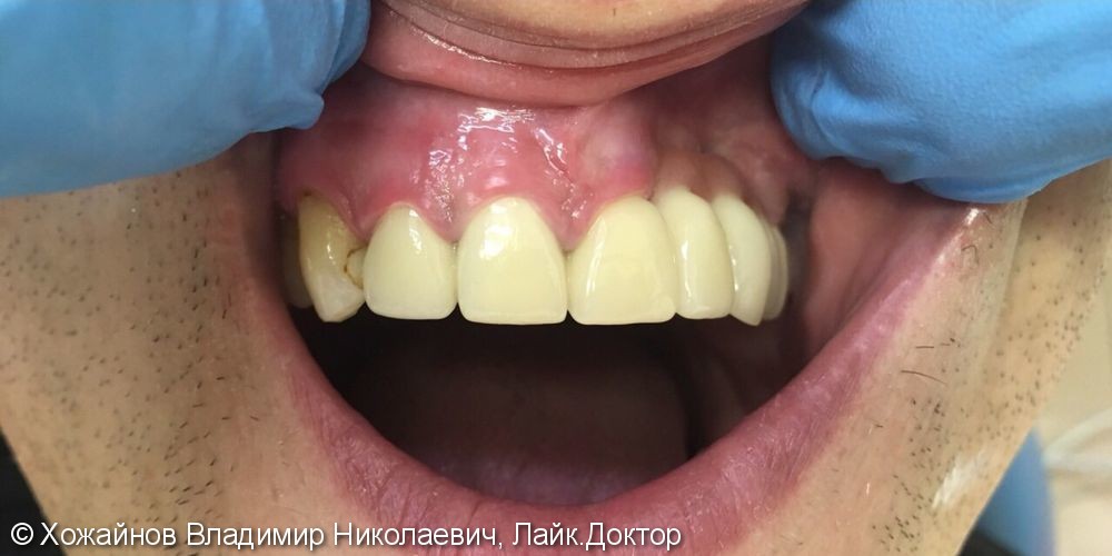Травма в области 4 зубов верхней челюсти - фото №2