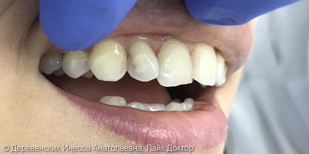 Художественная реставрация зуба 12 светоотверждаемым композитным материалом - фото №1