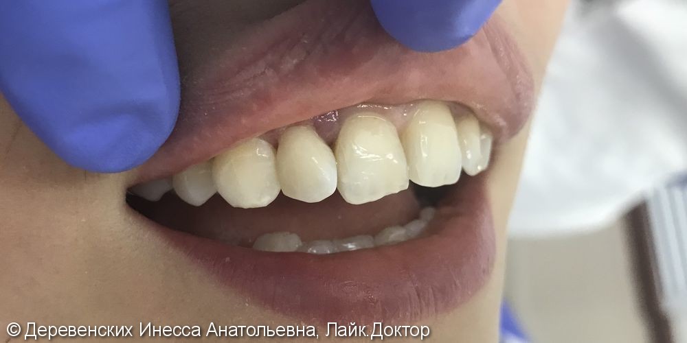 Художественная реставрация зуба 12 светоотверждаемым композитным материалом - фото №2