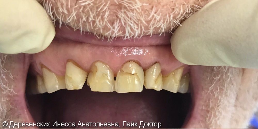 Вторичный кариес 6 зубов верхней челюсти, до и после лечения - фото №1