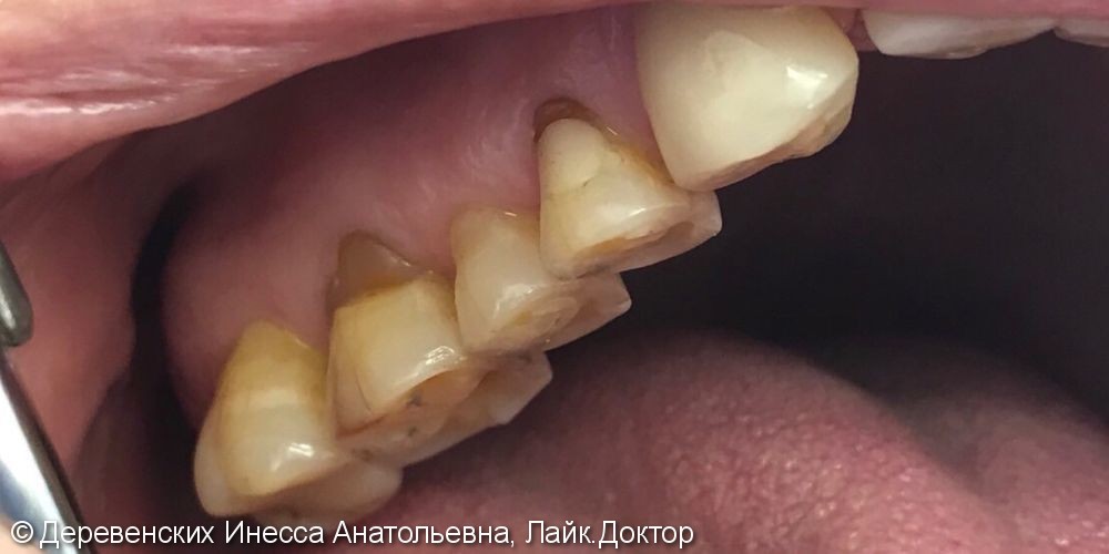 Реставрация зубов наногибридным композитным материалом Filtek z550, 3M ESPE, USA - фото №1