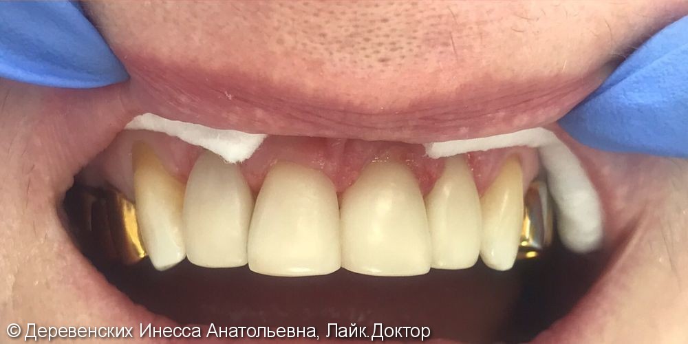 Эстетические реставрации зубов, материалы Filtekz550, Filtekz250 - фото №2