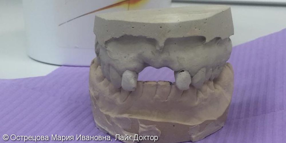 Пациент утратил зубы в следствии осложнений кариеса - фото №1