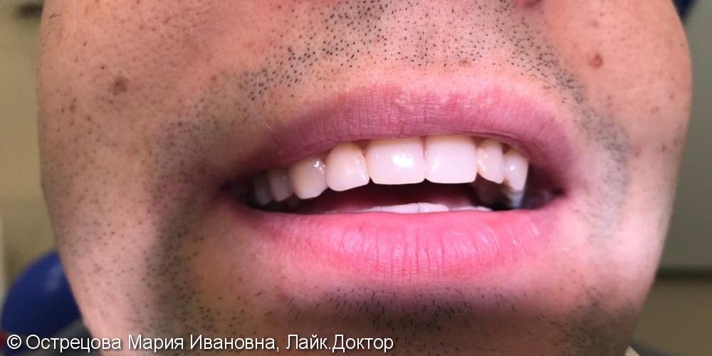 Пациент утратил зубы в следствии осложнений кариеса - фото №5