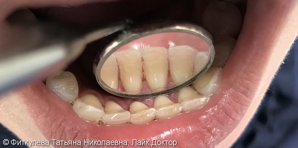 Профессиональная чистка зубов от зубного камня, лечение кровоточивости десен - фото №2