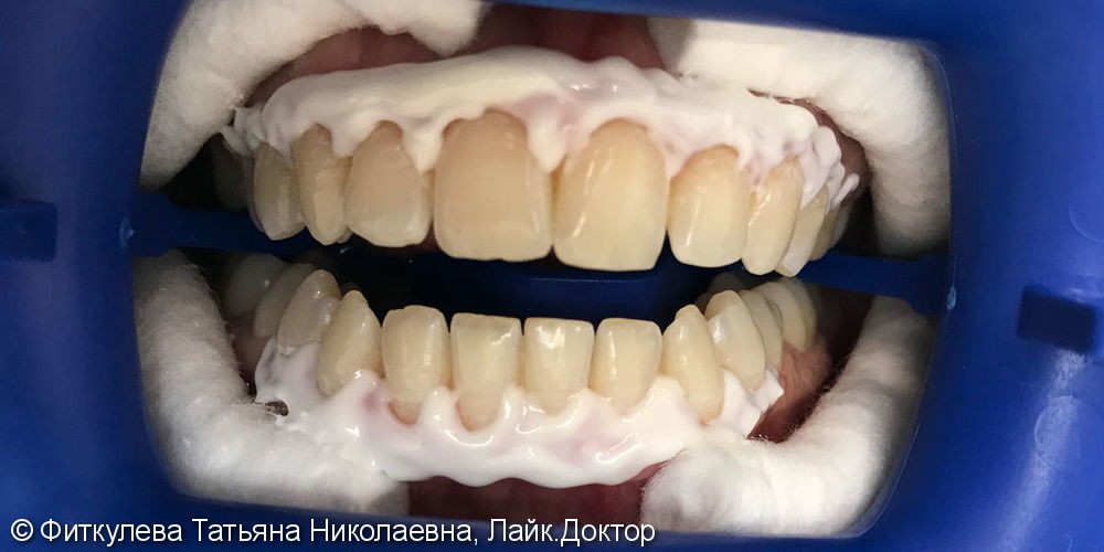 Гигиена Аэр-флоу + отбеливание зубов ZOOM 4, до и после - фото №1