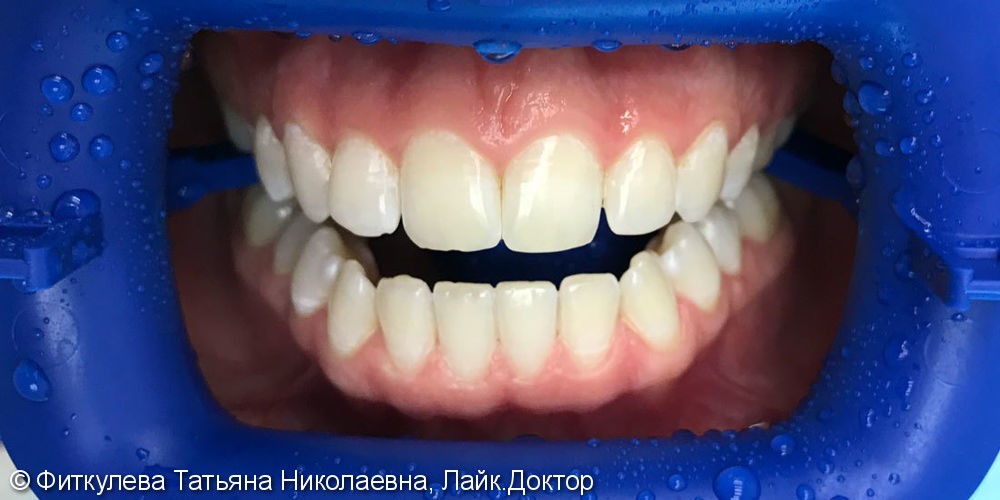 Гигиена Аэр-флоу + отбеливание зубов ZOOM 4, до и после - фото №2