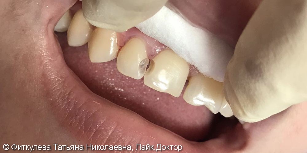 Кратковременные боли от сладкого, до и после лечения 2 передних зубов - фото №1