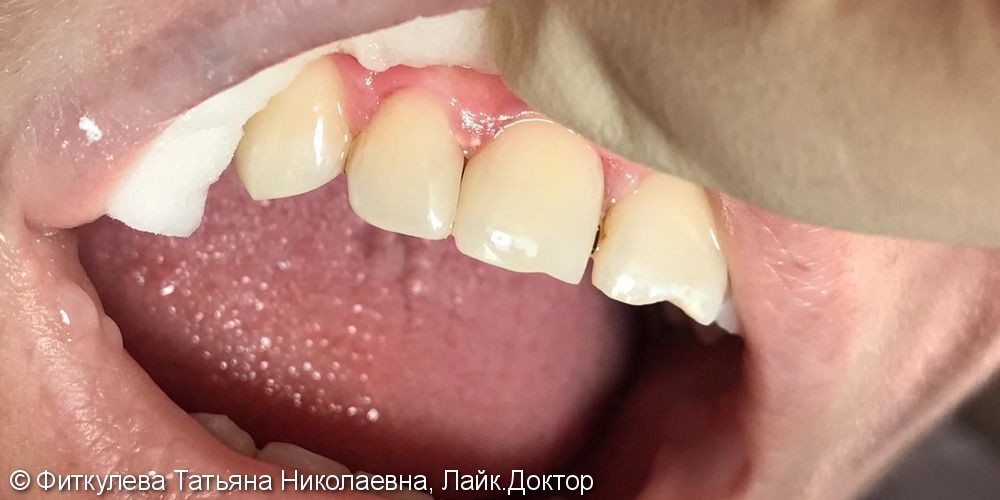 Кратковременные боли от сладкого, до и после лечения 2 передних зубов - фото №2