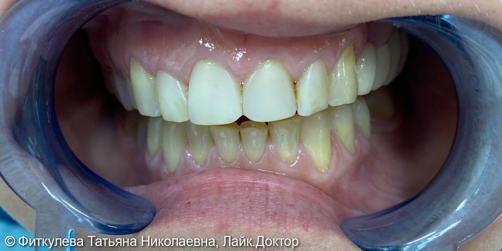 Реставрация зубов 1.2--2.2 - фото №1