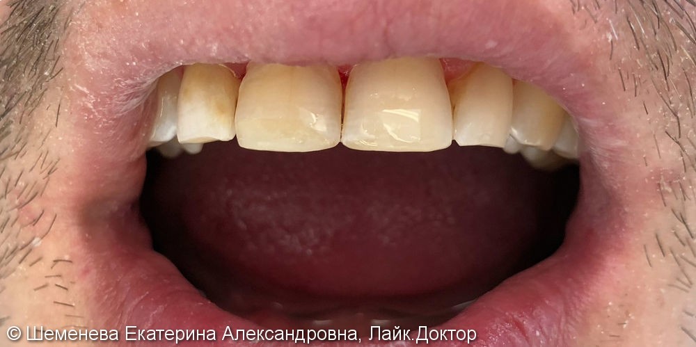 Эстетическая реставрация зубов наногибридным композитным материалом Ceram xDuo - фото №2
