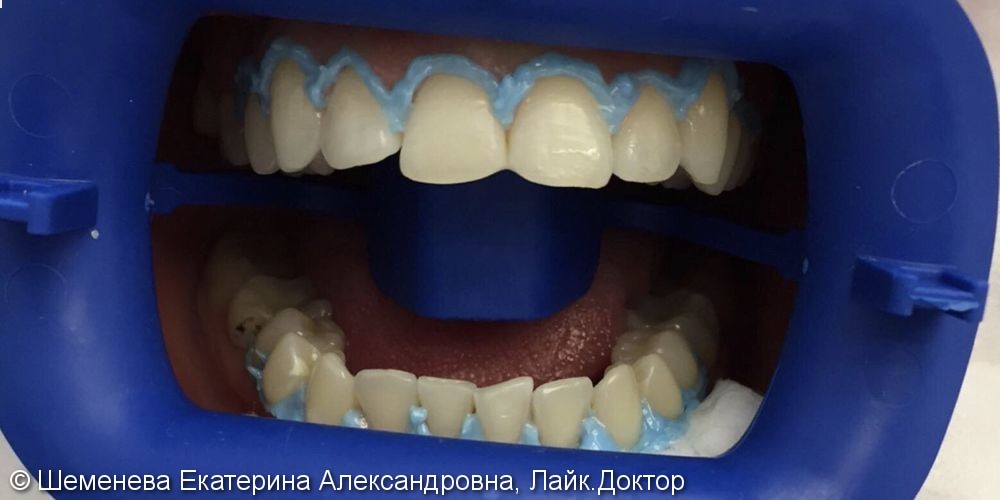 Результат до и после отбеливания зубов Philips Zoom-3 - фото №1