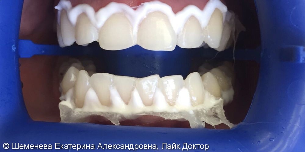 Результат до и после отбеливания зубов Philips Zoom-3 - фото №2