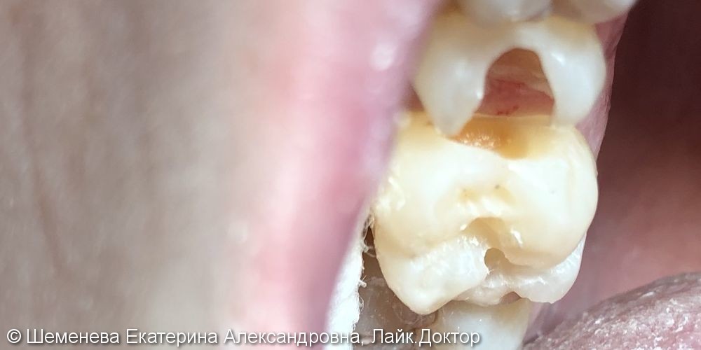 Хронический фиброзный пульпит зуба 1.5, глубокий кариес зуба 1.6 - фото №1